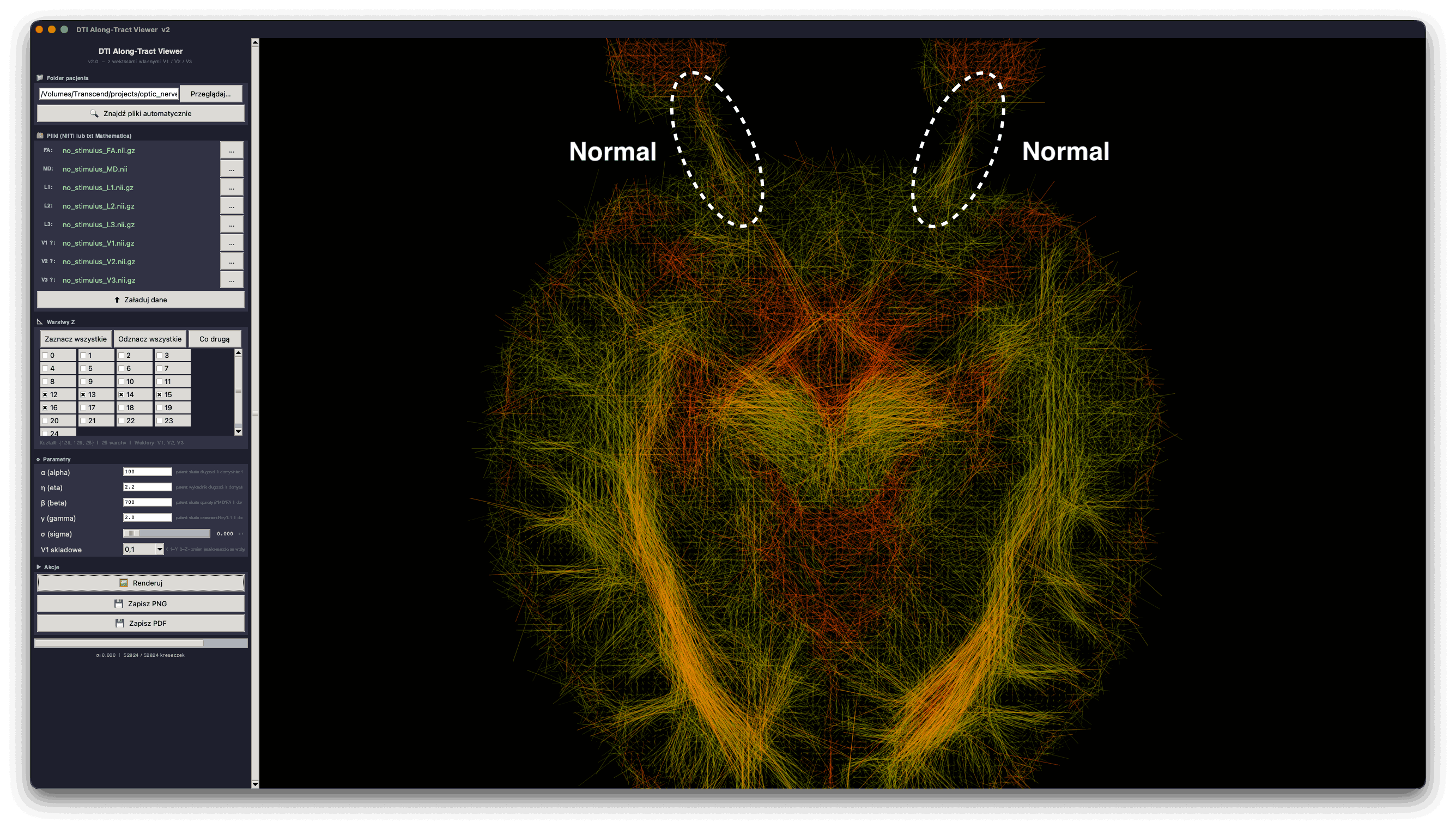 DTI Along-Tract Viewer – wizualizacja nerwów